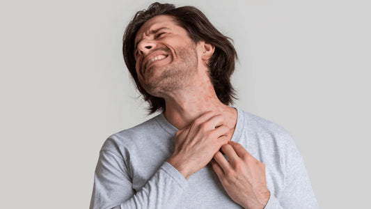 3 Myths About Eczema Debunked: What You Really Need to Know - Puretive Botanics
