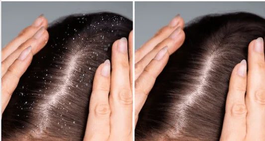 5 Natural Hacks to Outsmart Dandruff and Flaunt a Flawless Scalp - Puretive Botanics