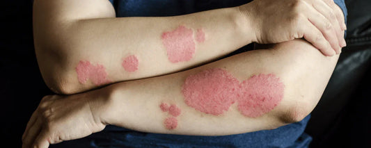 Nature's Toolbox: Unveiling Natural Remedies for Psoriasis - Puretive Botanics