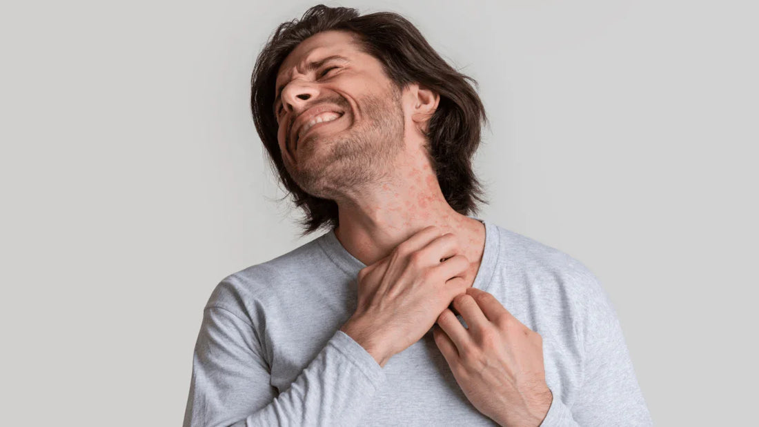 3 Myths About Eczema Debunked: What You Really Need to Know - Puretive Botanics