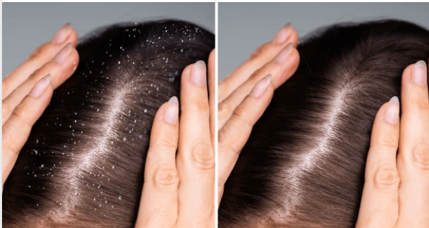 5 Natural Hacks to Outsmart Dandruff and Flaunt a Flawless Scalp