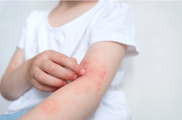 Ditch the Itch: Natural Remedies for Dermatitis Relief