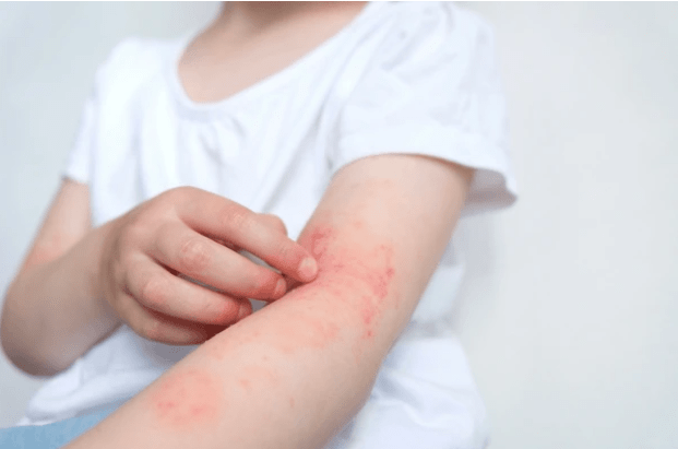 Ditch the Itch: Natural Remedies for Dermatitis Relief - Puretive Botanics