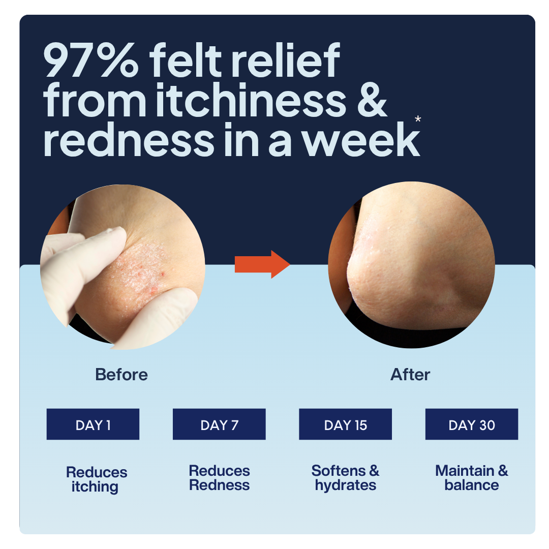 Psori Ease Body & Scalp Oil